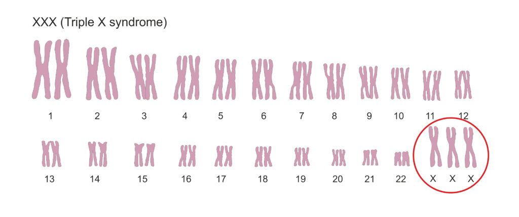 een afbeelding van de chromosomen bij triple X syndroom: 47 figuurtjes, van het X chromosoom zijn er 3 in plaats van 2  